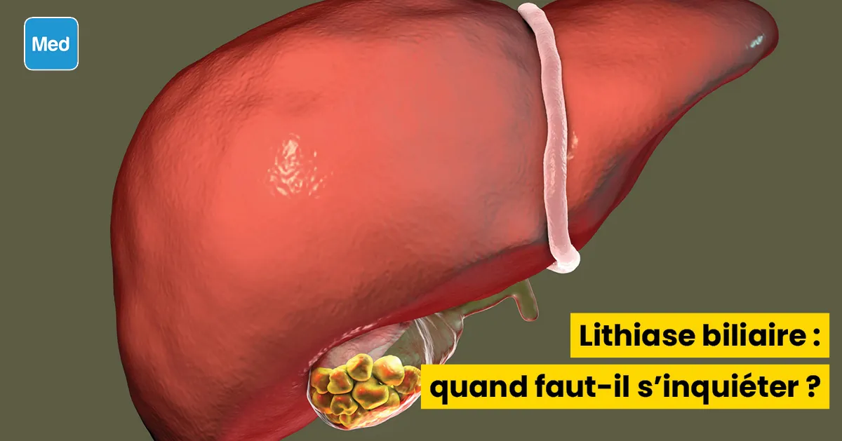 Lithiase biliaire : quand faut-il s'inquiéter ?